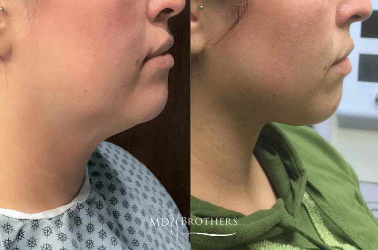 Before and After Image: Lower Face Fat Removal - right-side