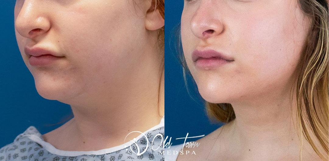 Before and After Image: Lower Face Fat Removal - left-front-oblique
