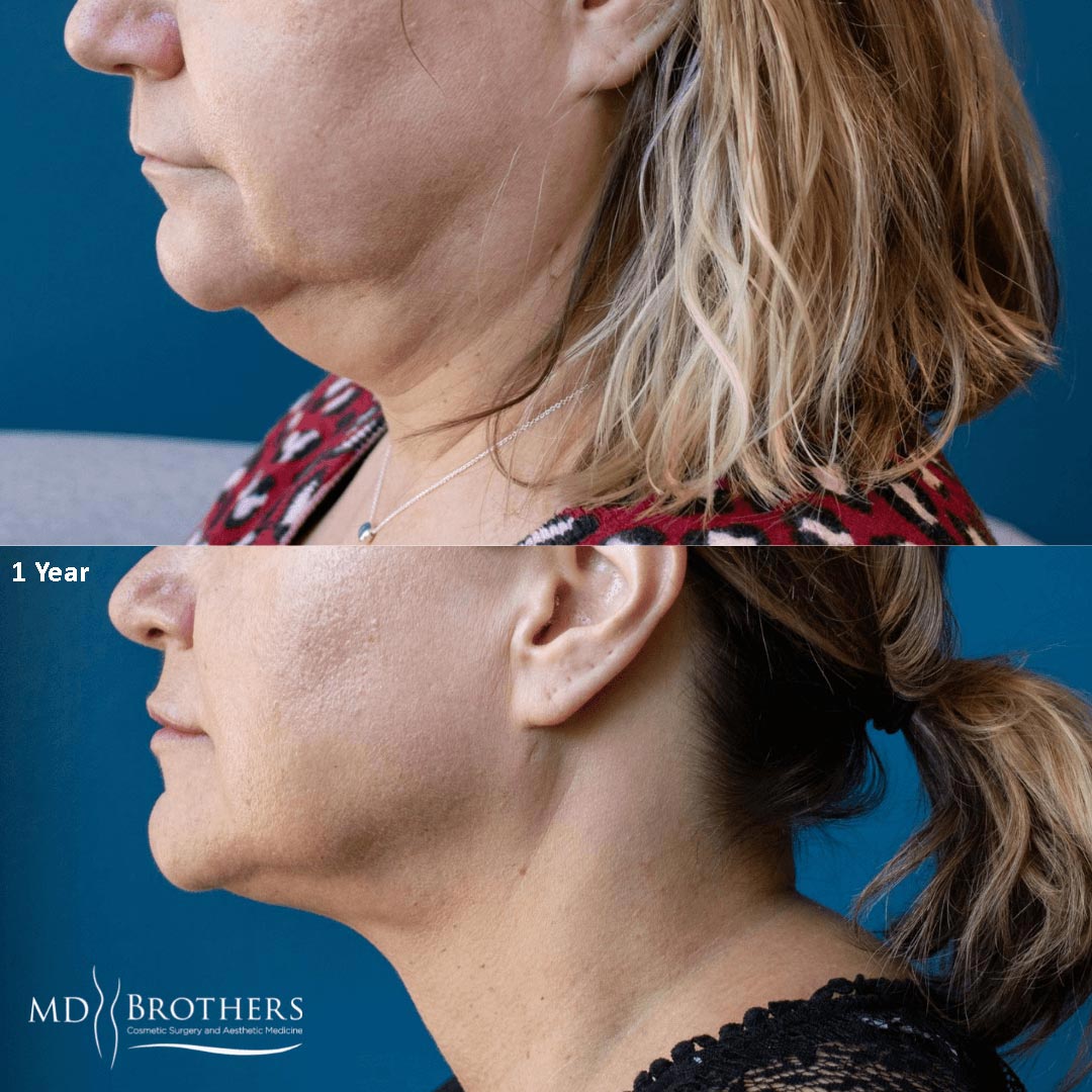 Before and After Image: Lower Face Fat Removal - left-side