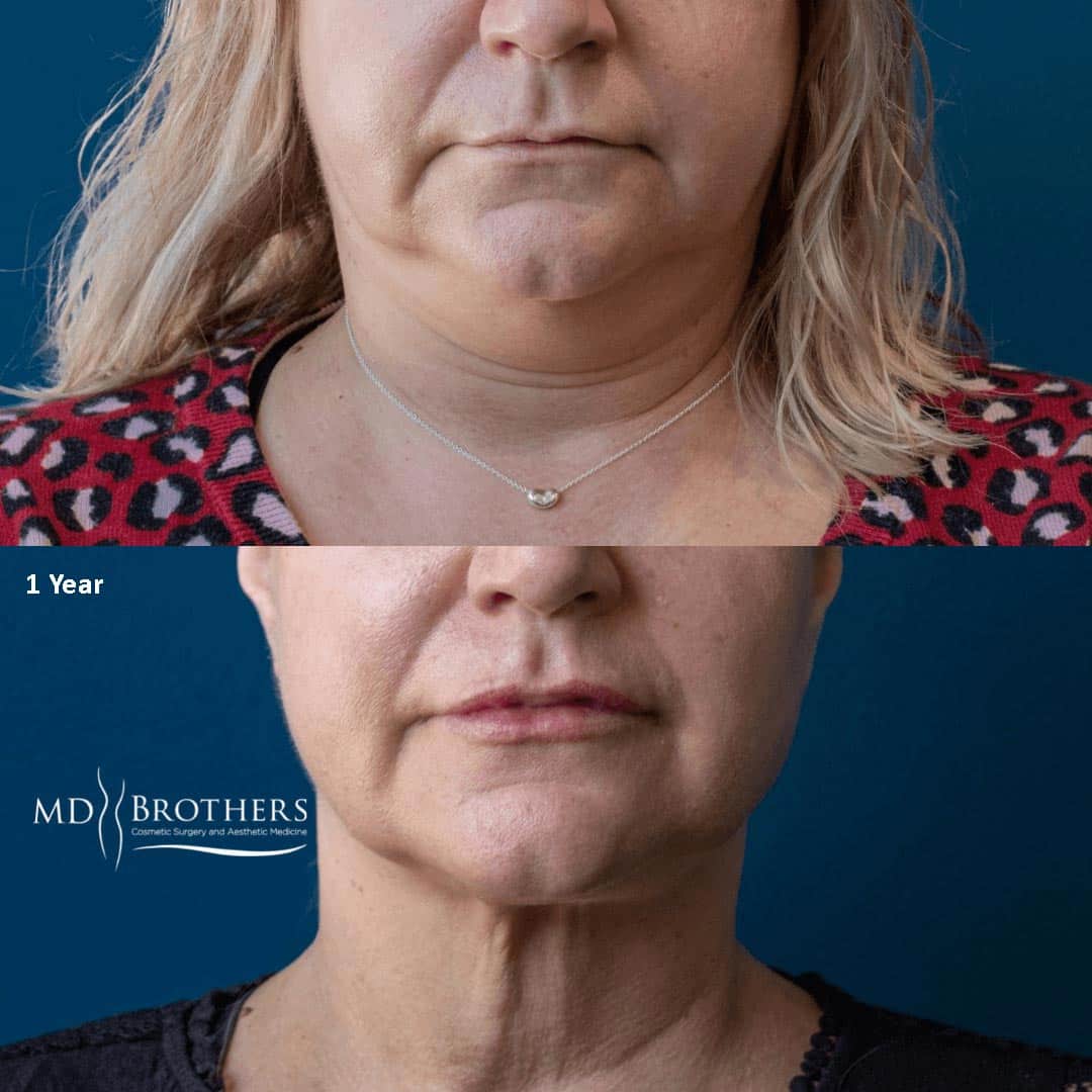 Before and After Image: Lower Face Fat Removal - front