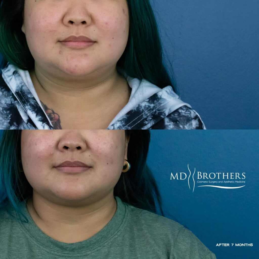 Before and After Image: Lower Face Fat Removal - front