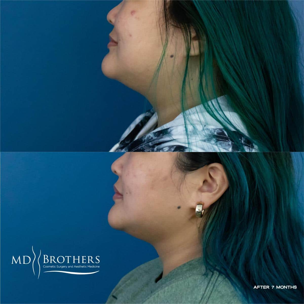 Before and After Image: Lower Face Fat Removal - left-side