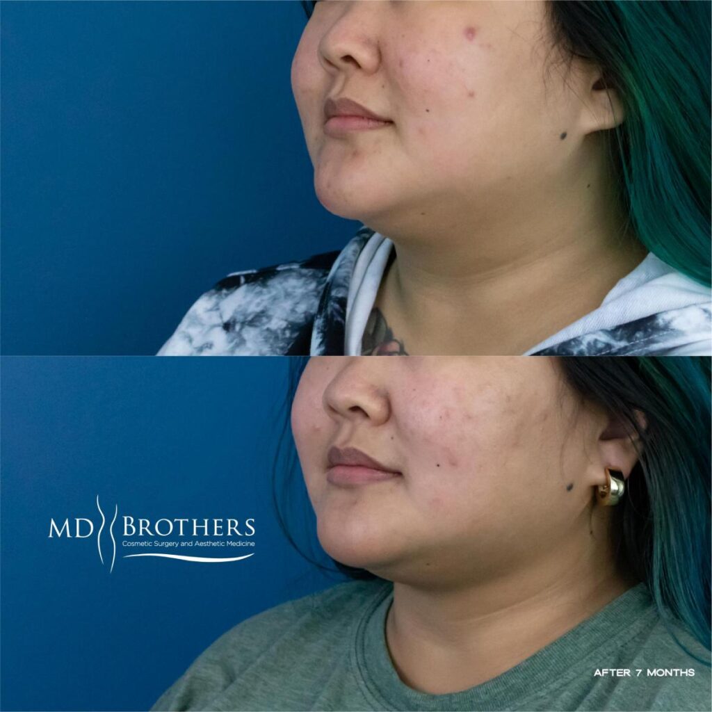 Before and After Image: Lower Face Fat Removal - left-front-oblique