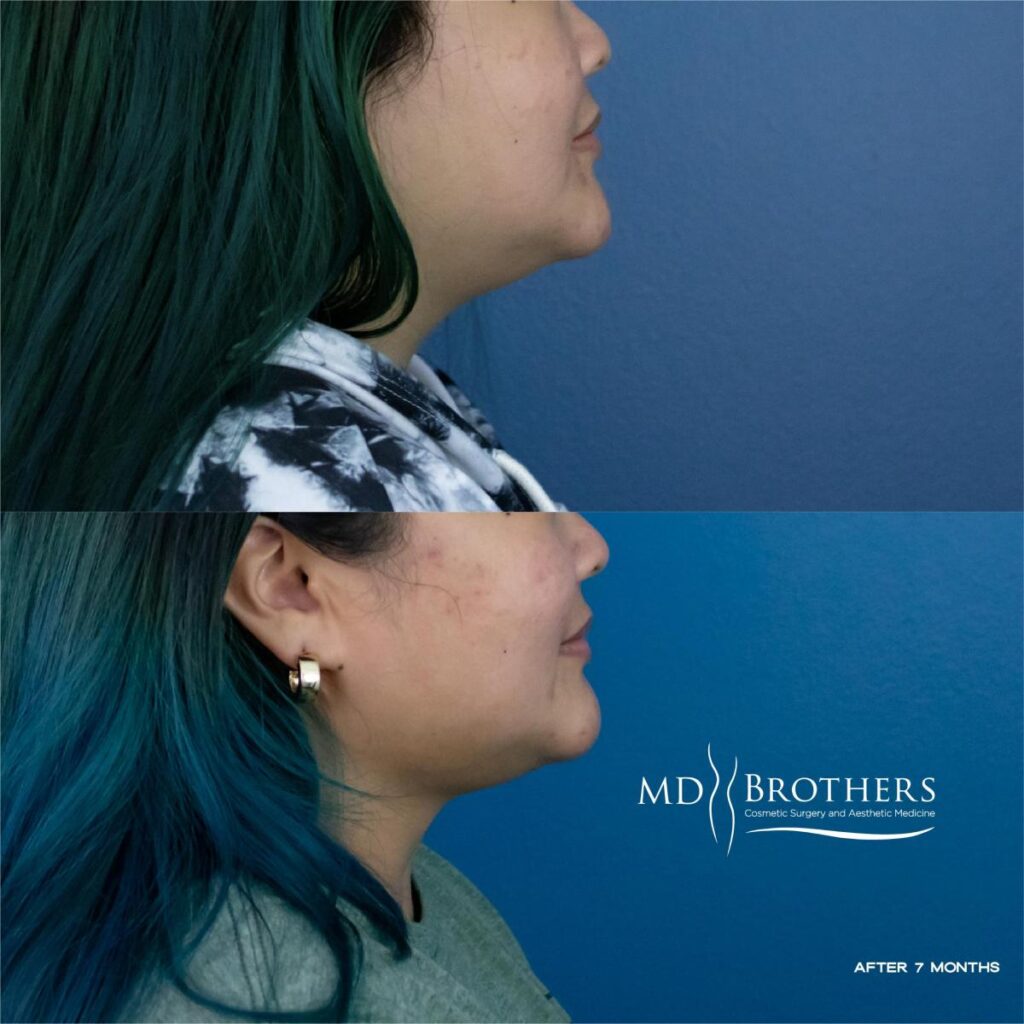 Before and After Image: Lower Face Fat Removal - right-side