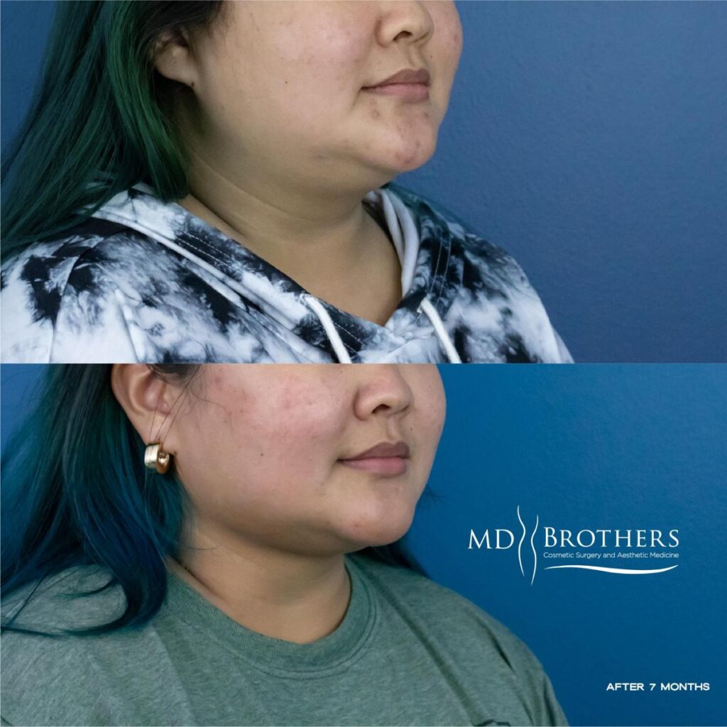 Before and After Image: Lower Face Fat Removal - right-front-oblique