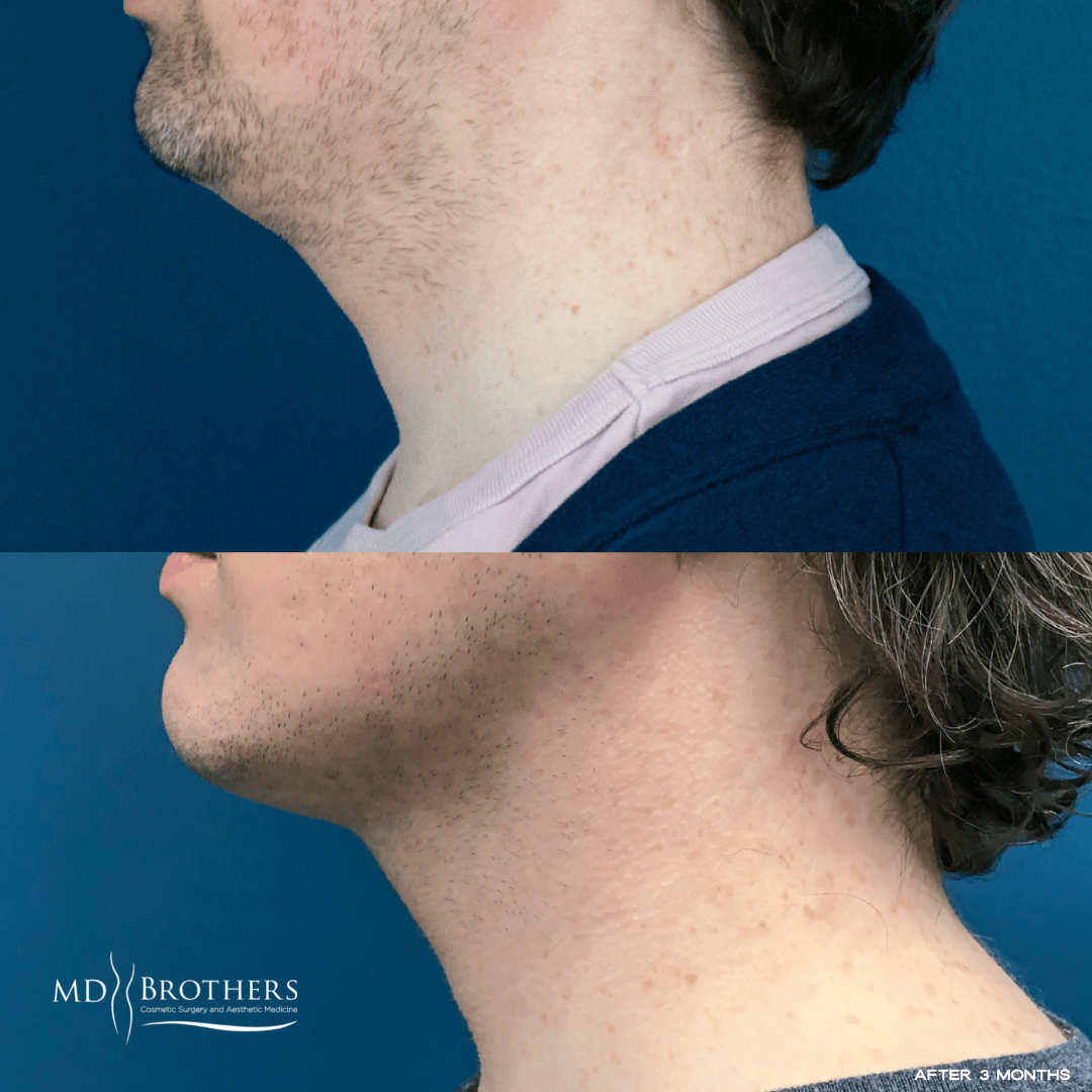 Before and After Image: Lower Face Fat Removal - left-side
