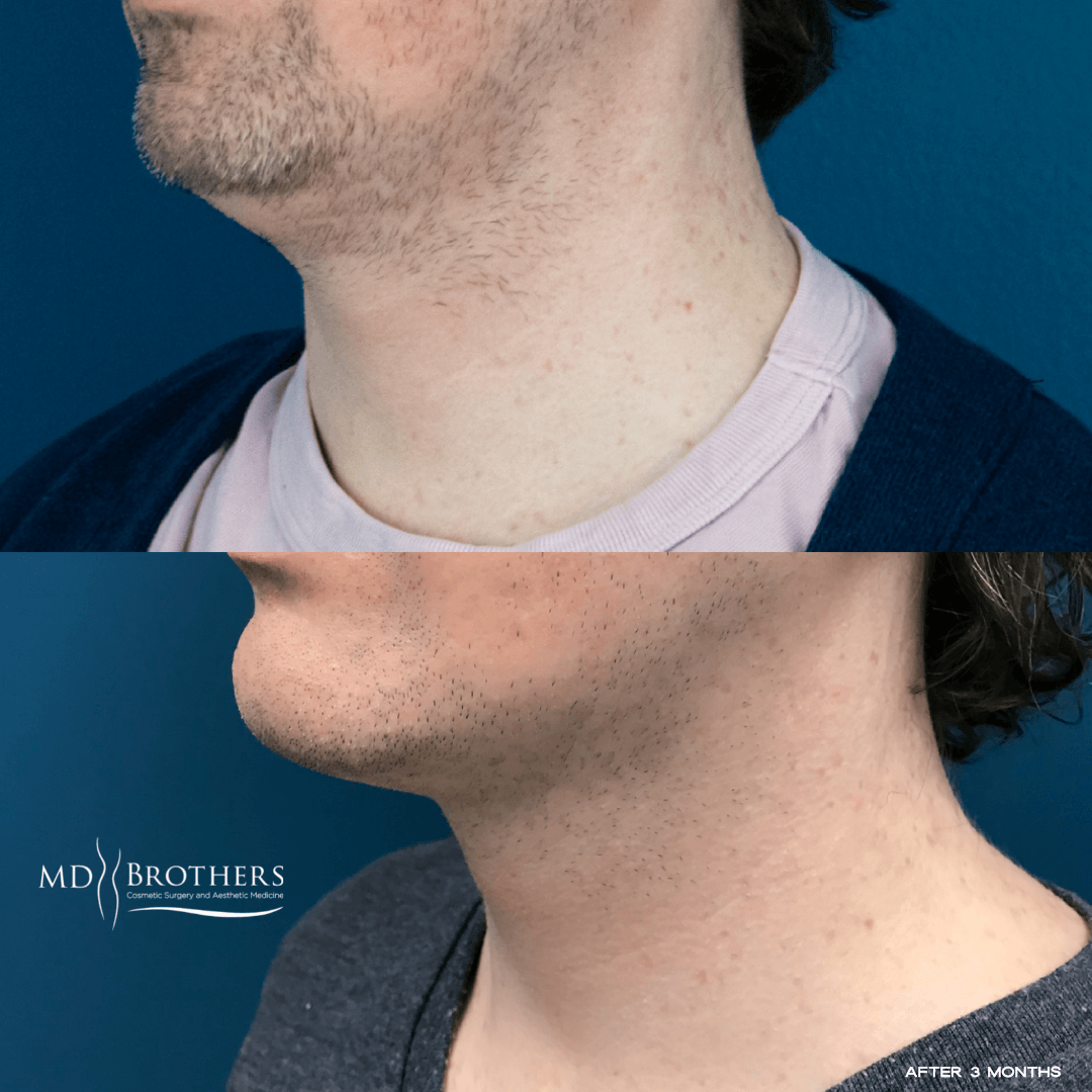 Before and After Image: Lower Face Fat Removal - left-front-oblique