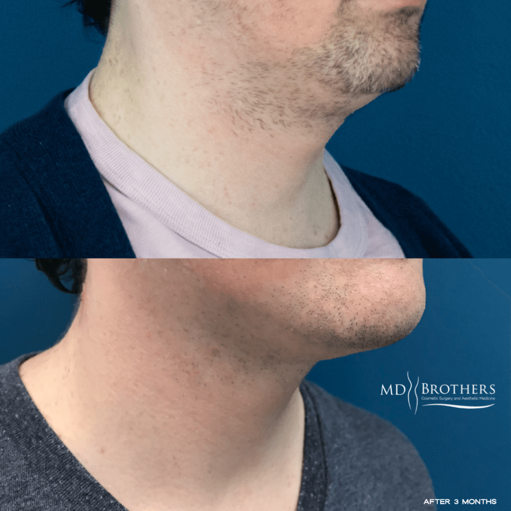 Before and After Image: Lower Face Fat Removal - right-front-oblique