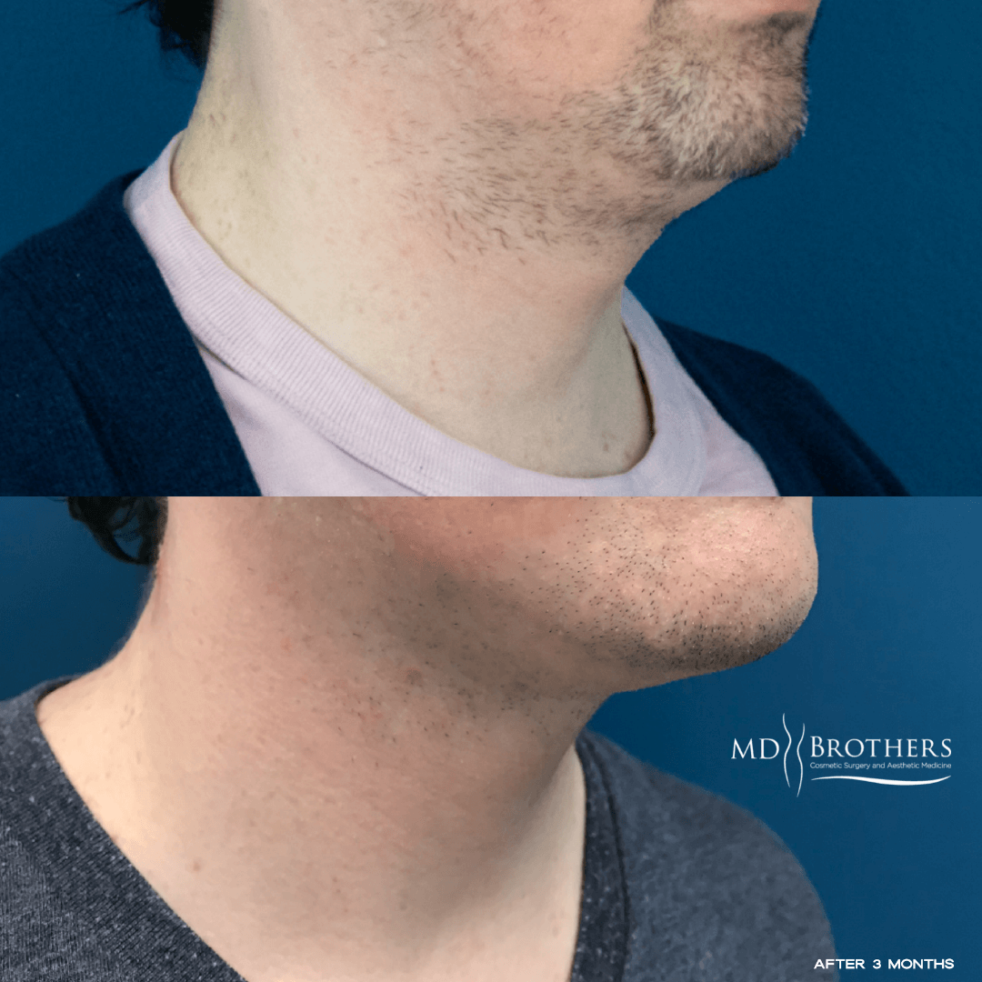 Before and After Image: Lower Face Fat Removal - right-front-oblique