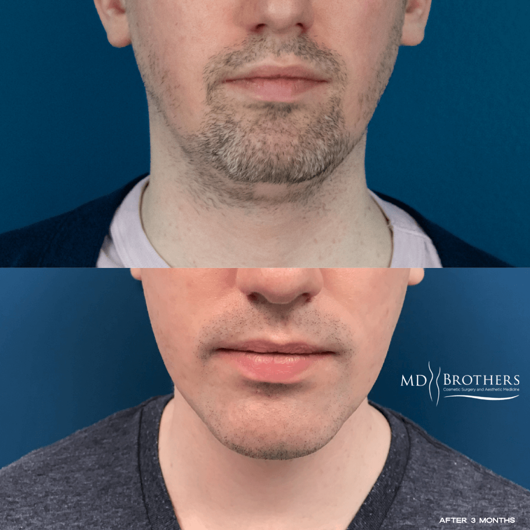 Before and After Image: Lower Face Fat Removal - front