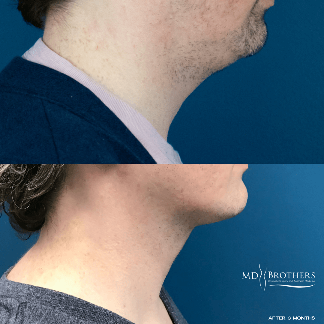 Before and After Image: Lower Face Fat Removal - right-side