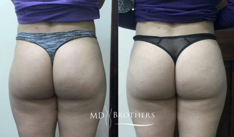 Before and After Image: Non-Surgical Butt Lift - back