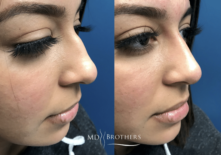 Before and After Image: Nose Filler - right-front-oblique