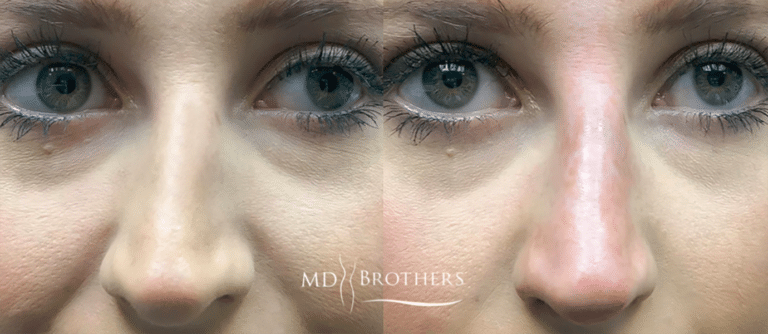 Before and After Image: Nose Filler - front