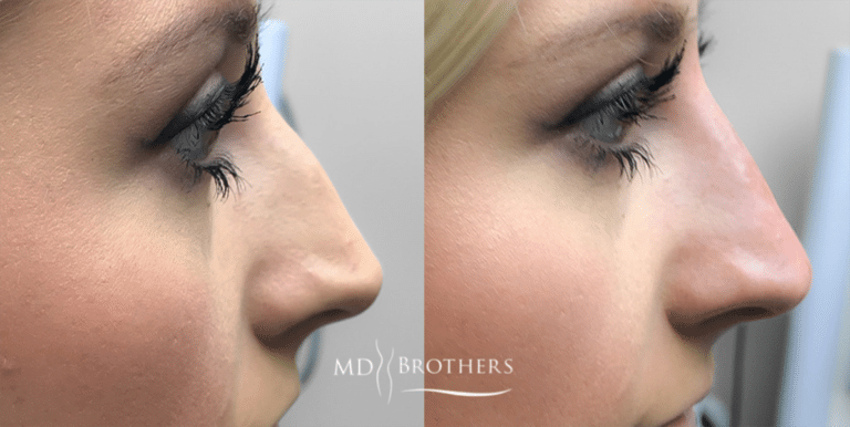 Before and After Image: Nose Filler - right-side