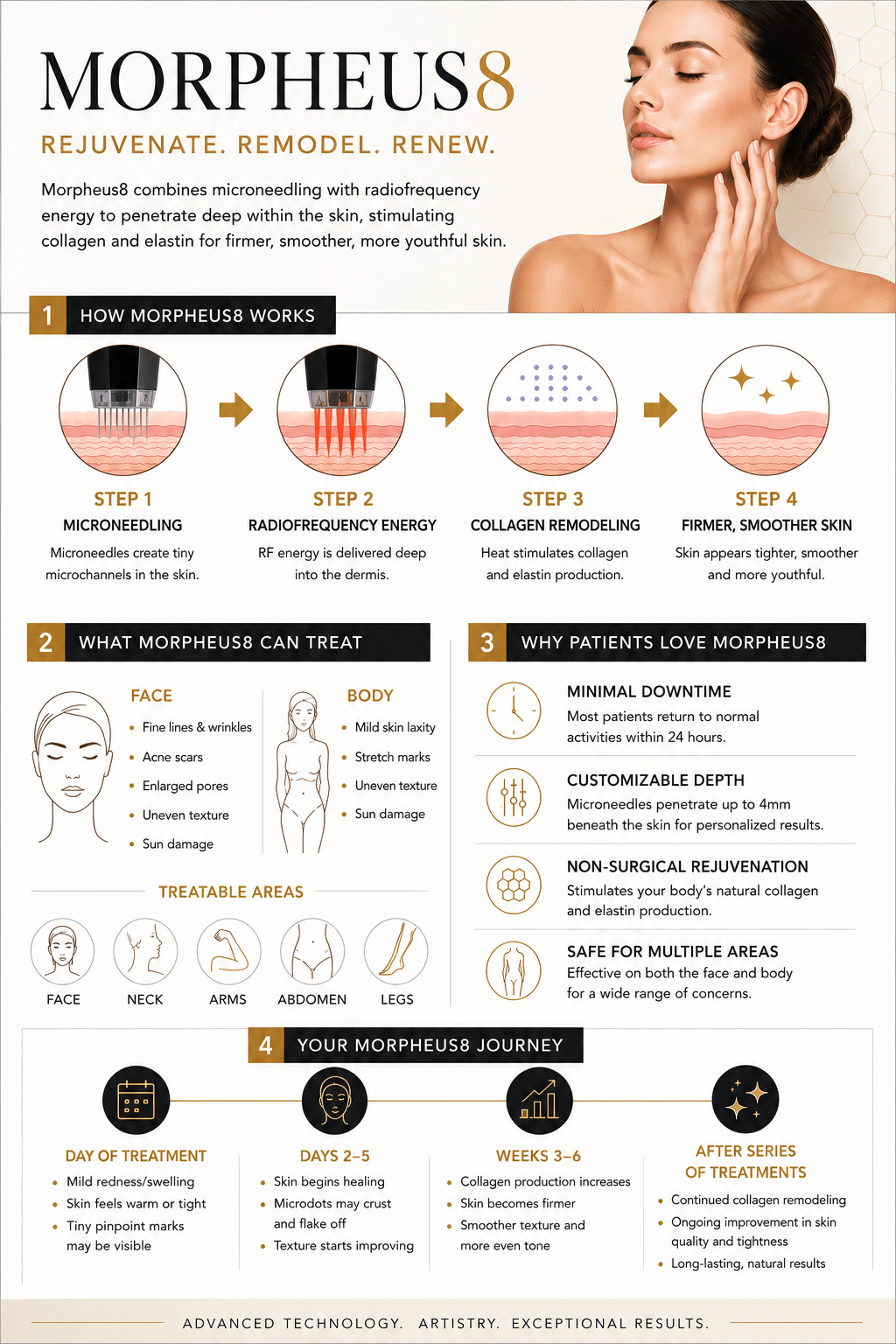 Morpheus8 infographic showing radiofrequency microneedling treatment process, benefits, treatment areas, and expected results timeline.