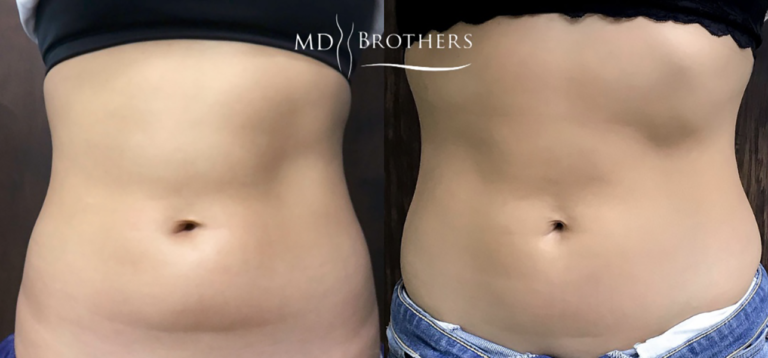 CoolsculptingBA-7-768x358