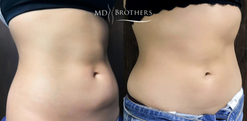 CoolsculptingBA-6-768x378