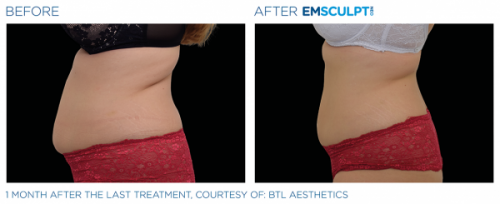 EmsculptNeo-BA3-p5moazej3pz91g5vh9sk9yp45lcqtttdy8189g3u6q