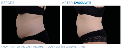 EmsculptNeo-BA4-p5mob281o8340a1s0t0fzfzhxqyugx4kylzop9zno2